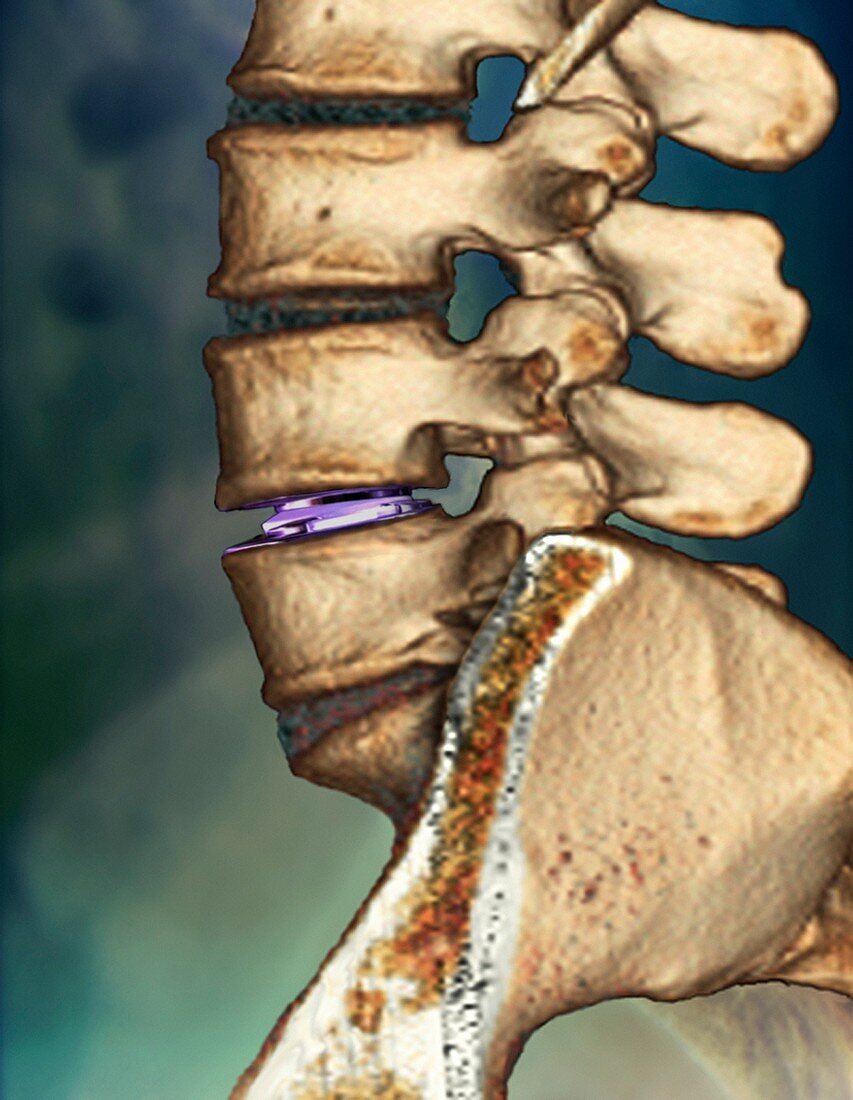 Spinal disc implant,3D CT scan