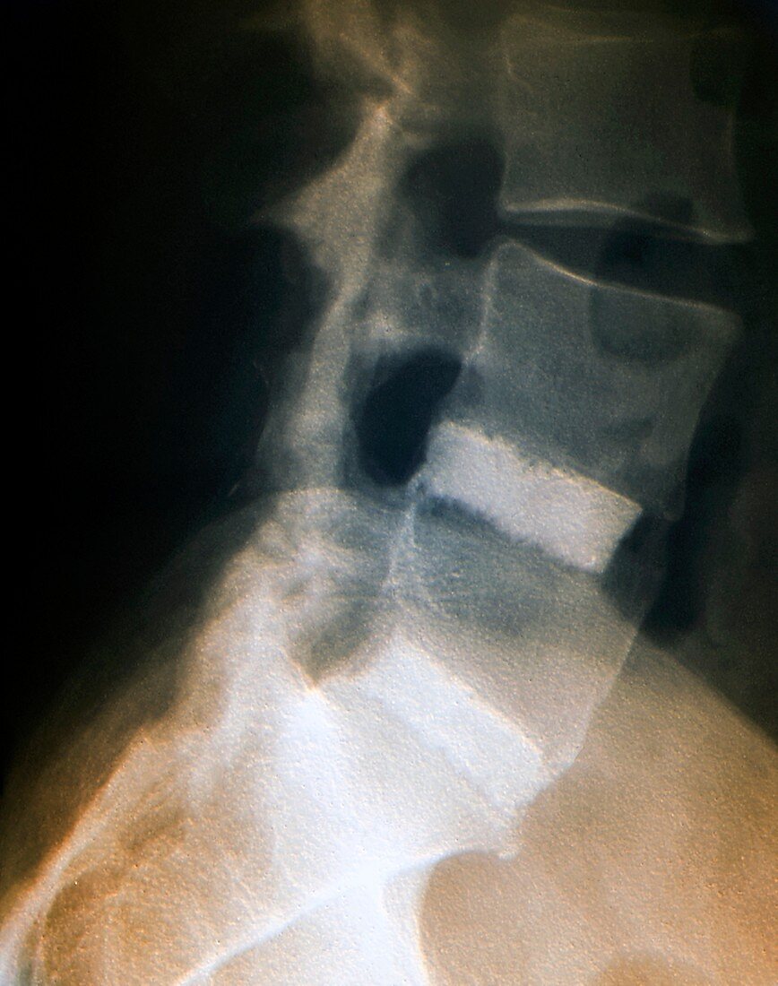 Spinal fusion for slipped discs,X-ray