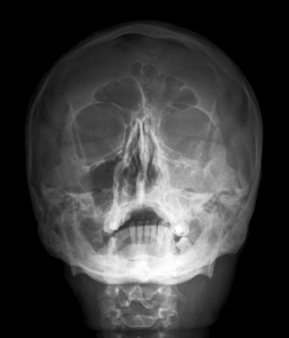Fractured skull,X-ray