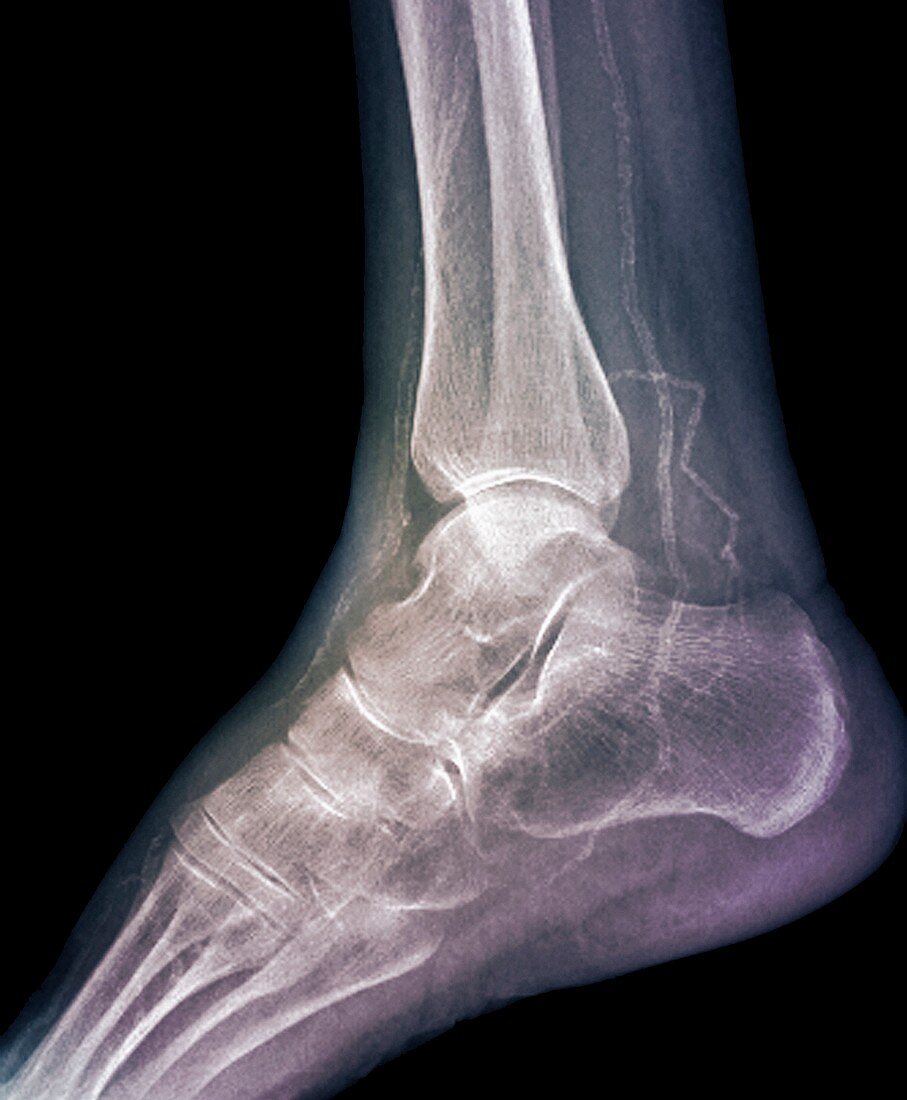 Calcified ankle arteries,X-ray