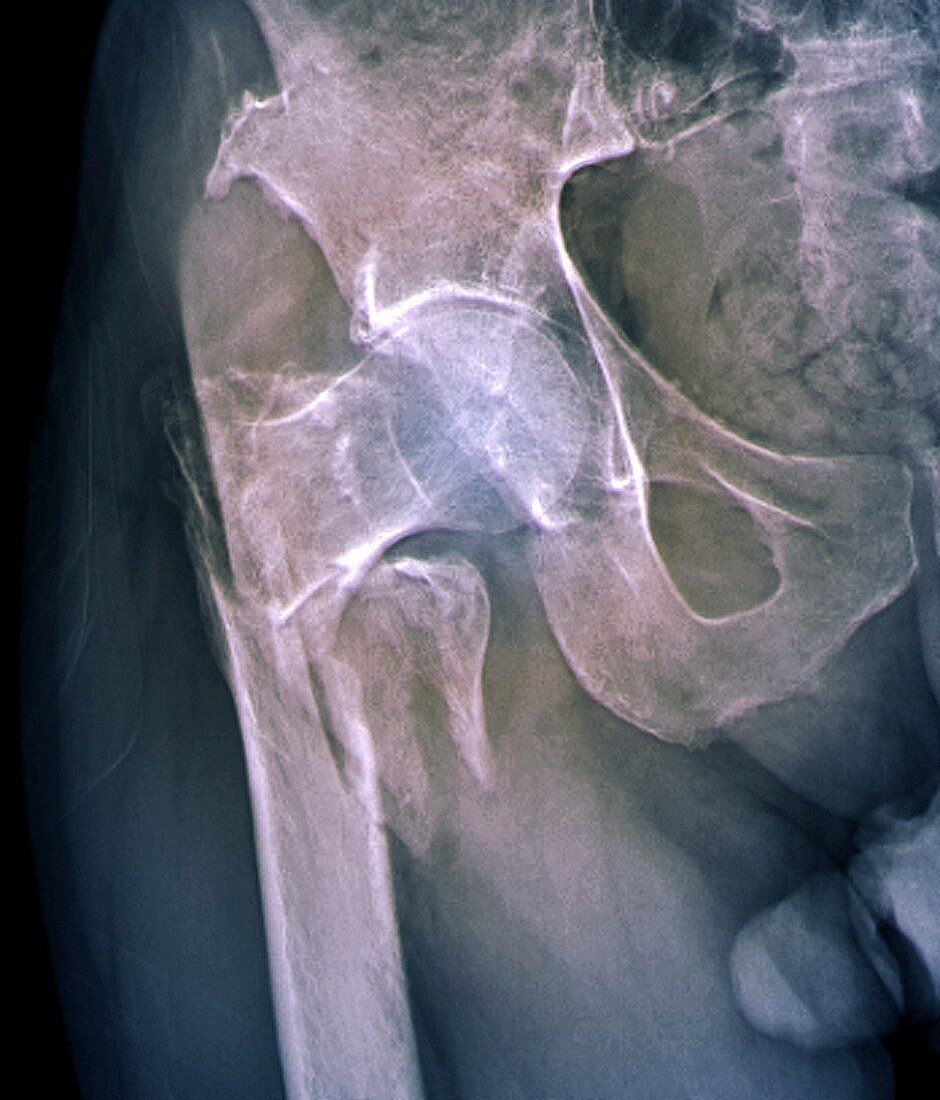 Fractured hip,X-ray