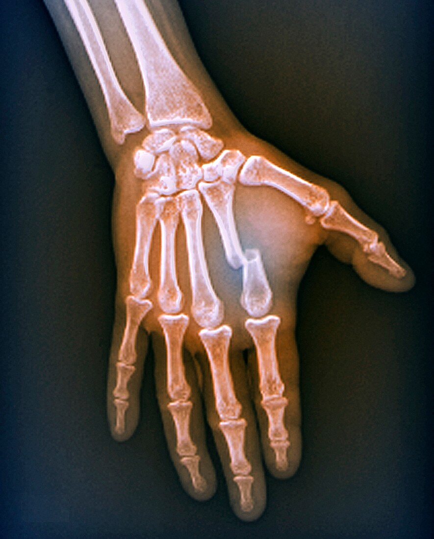 Fractured hand,X-ray