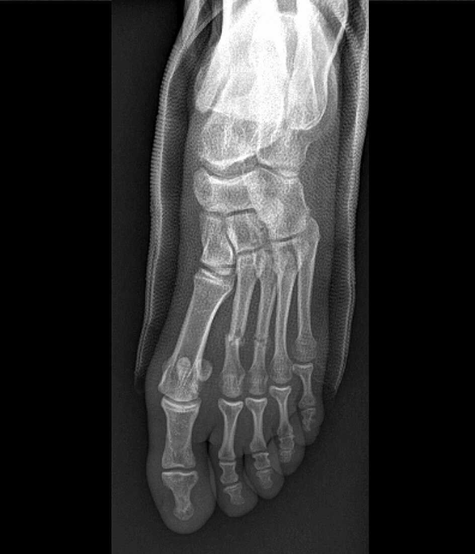 Broken toe in plaster,X-ray