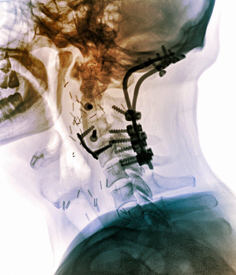 Fixed broken neck,X-ray
