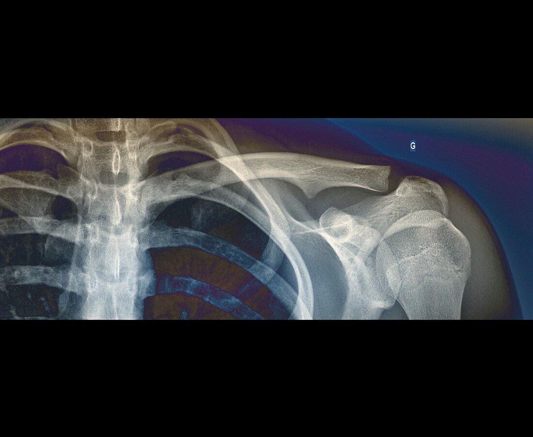 Normal shoulder,X-ray