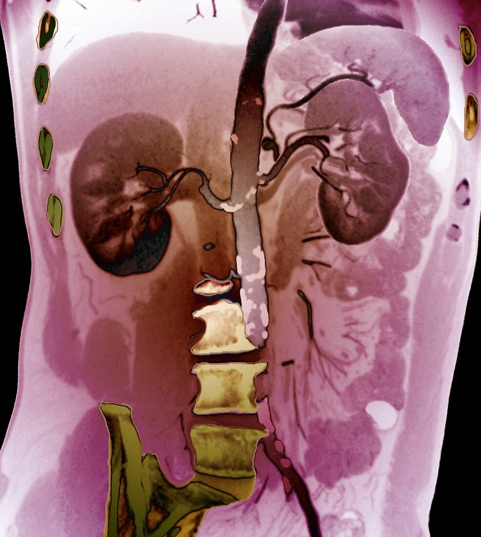 Aortic atherosclerosis,CT scan