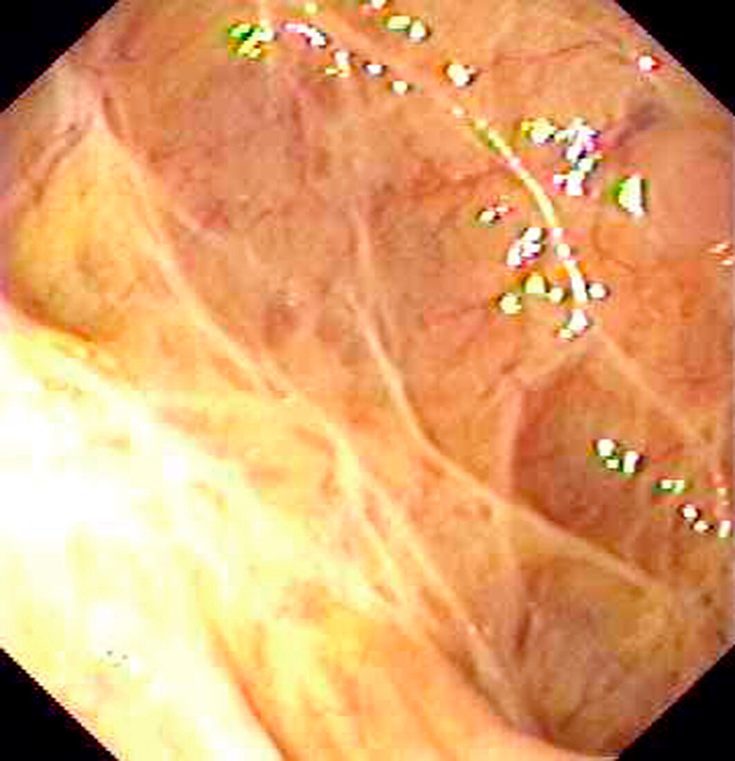 Mucosal scars in ulcerative colitis