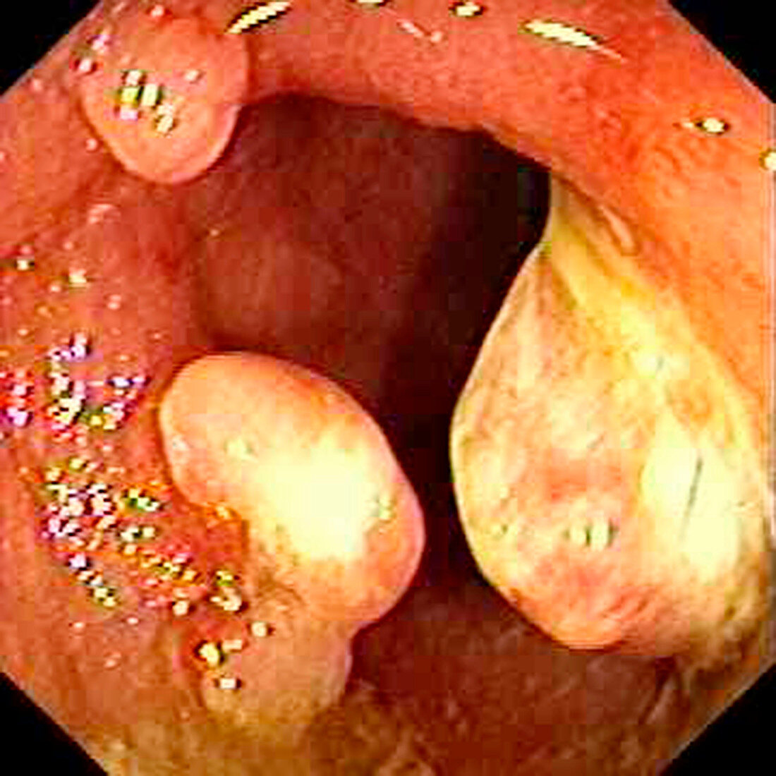 Inflammatory polyps in ulcerative colitis