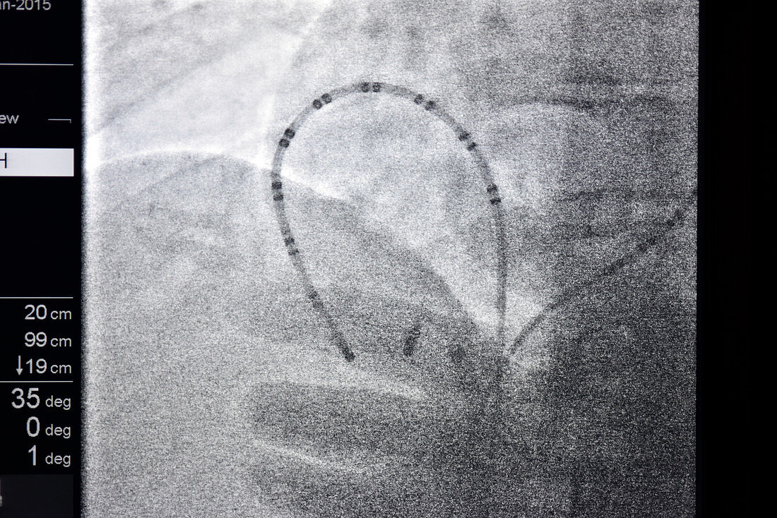 Cardiac ablation surgery,heart X-ray