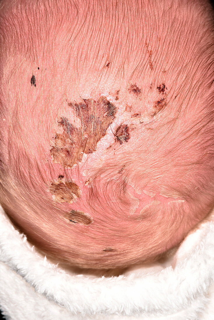 Post-birth scalp abrasions