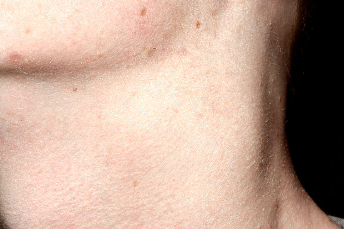 Enlarged lymph nodes