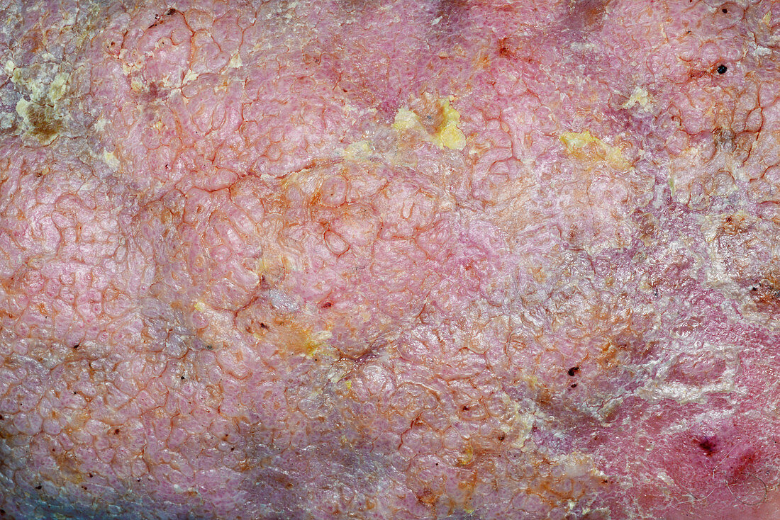 Lichen planus