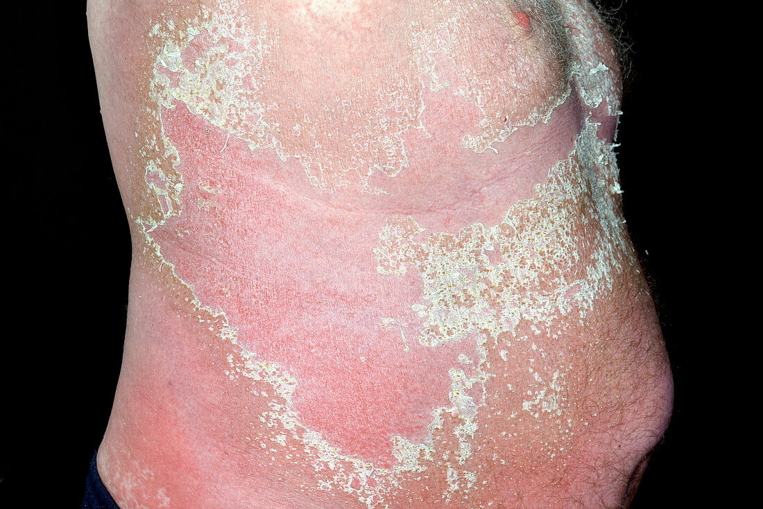 Skin peeling in allergic reaction
