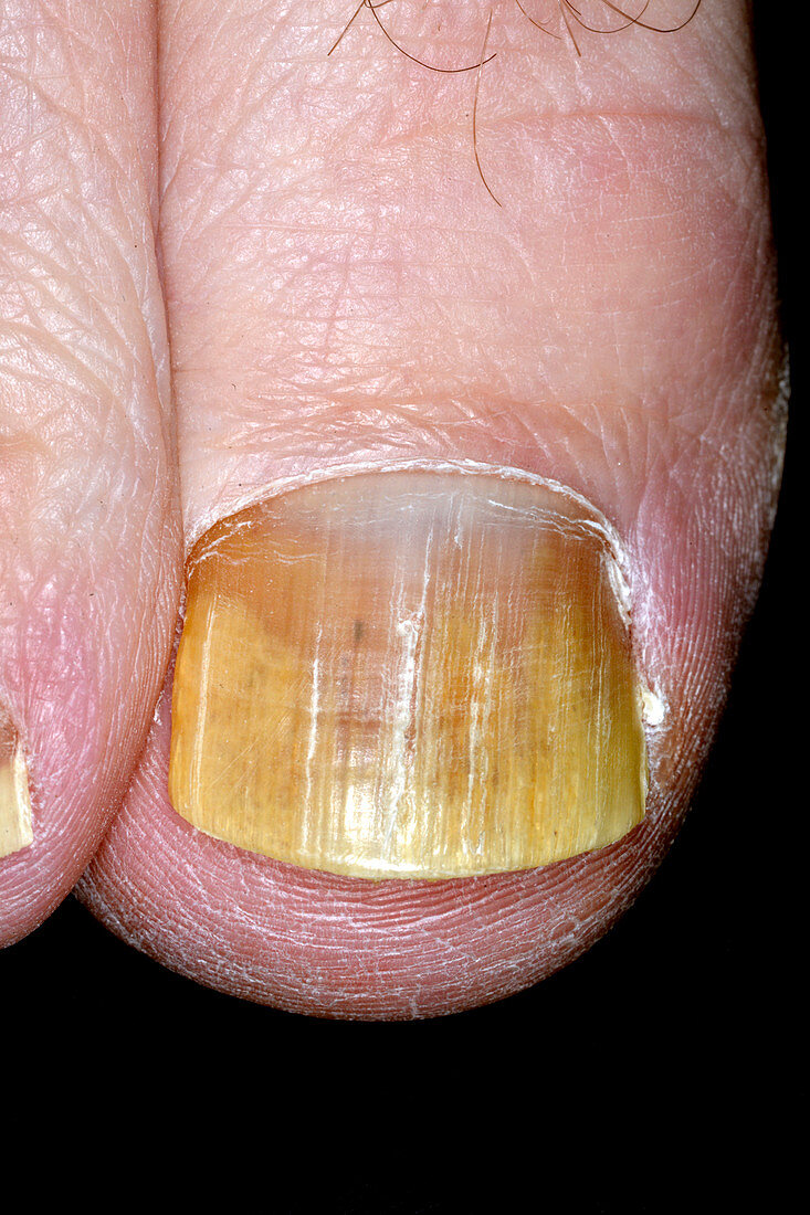 Fungal nail infection after treatment