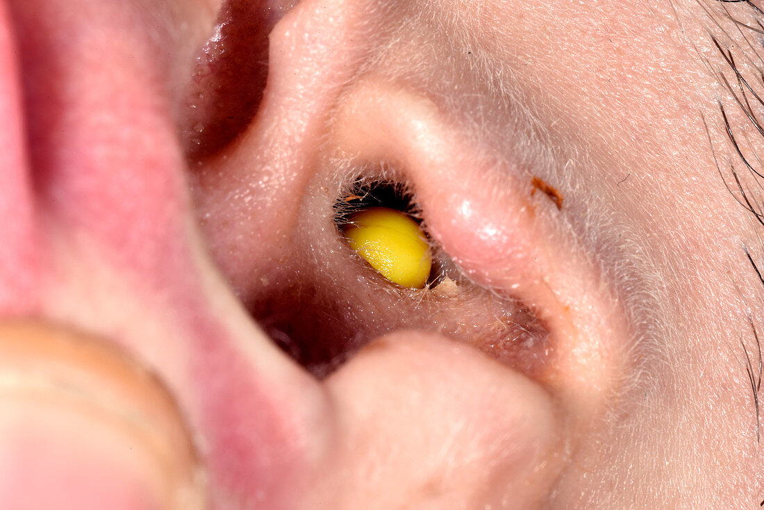Plastic pellet lodged in ear