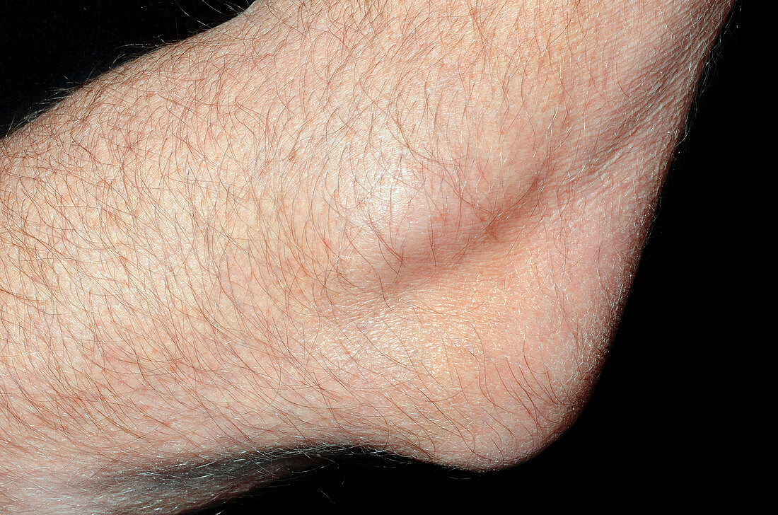 Bursitis of the elbow