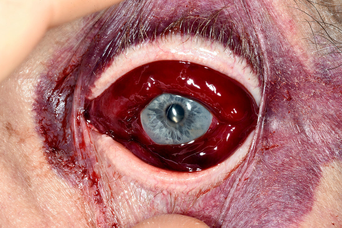 Subconjunctival haemorrhage after fall