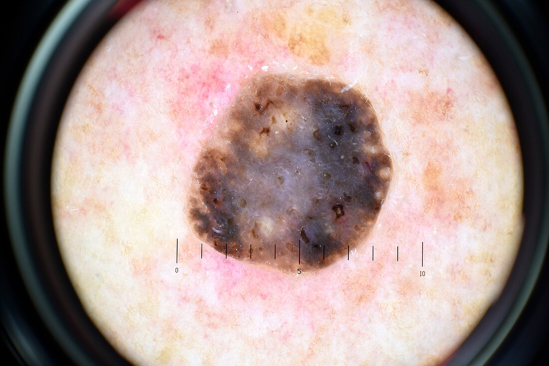 Seborrheic keratosis,dermatoscope image