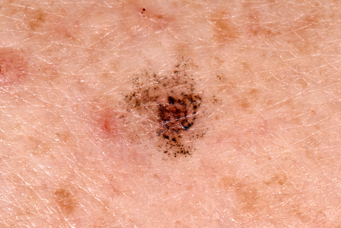 Post-inflammatory skin pigmentation