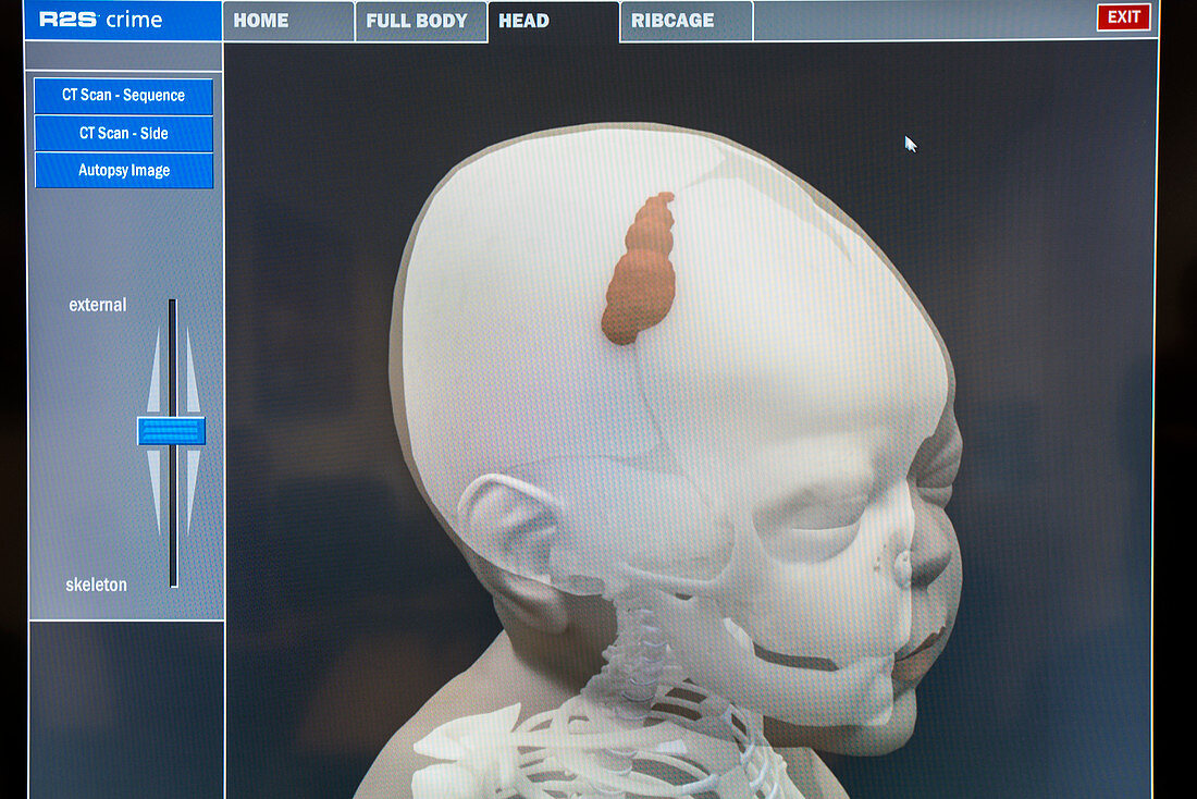 3D virtual autopsy of a child