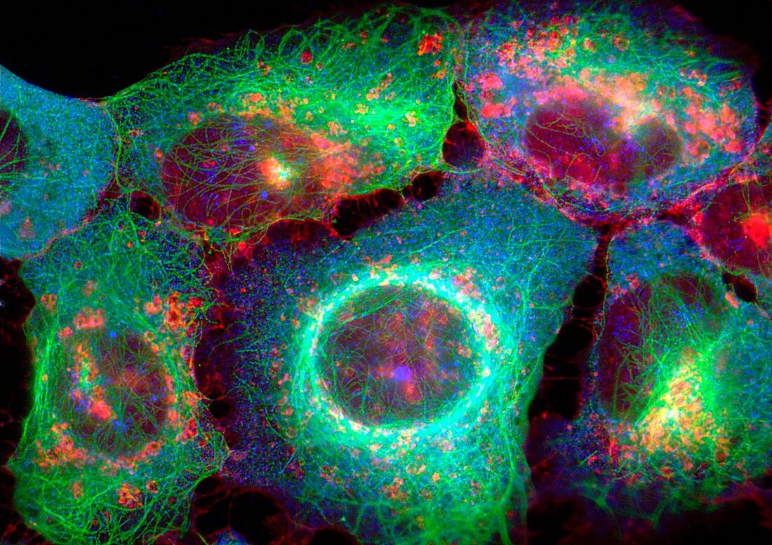 Osteosarcoma cells,light micrograph