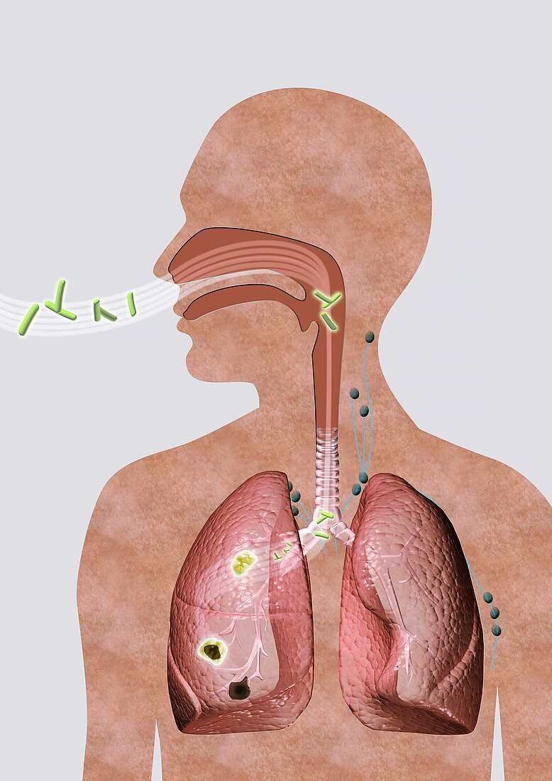 Progression of tuberculosis,illustration