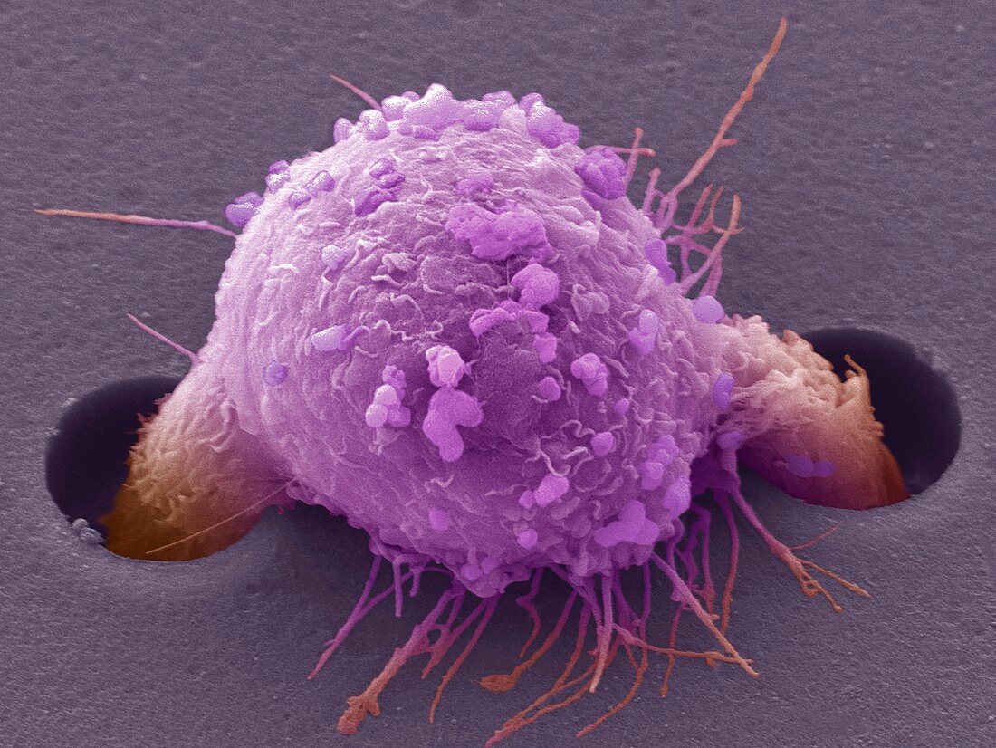 Breast cancer cell,SEM