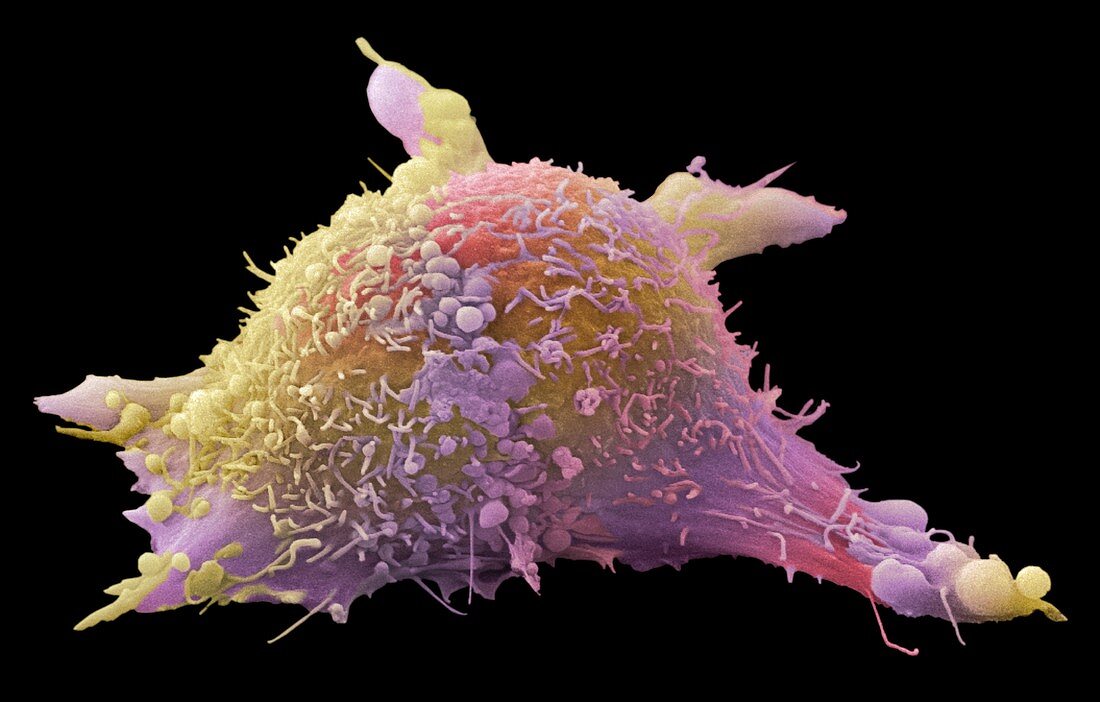 Skin cancer cell,SEM