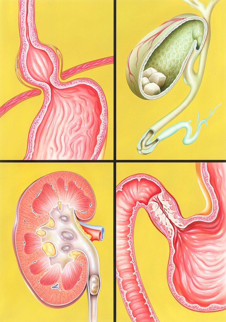 Digestive-excretory disorders,artwork