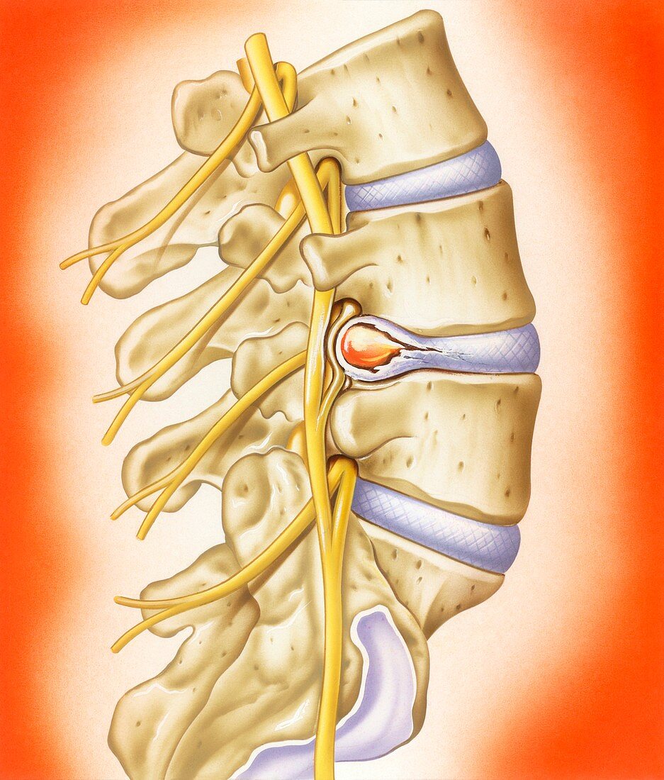 Slipped intervertebral disc,illustration