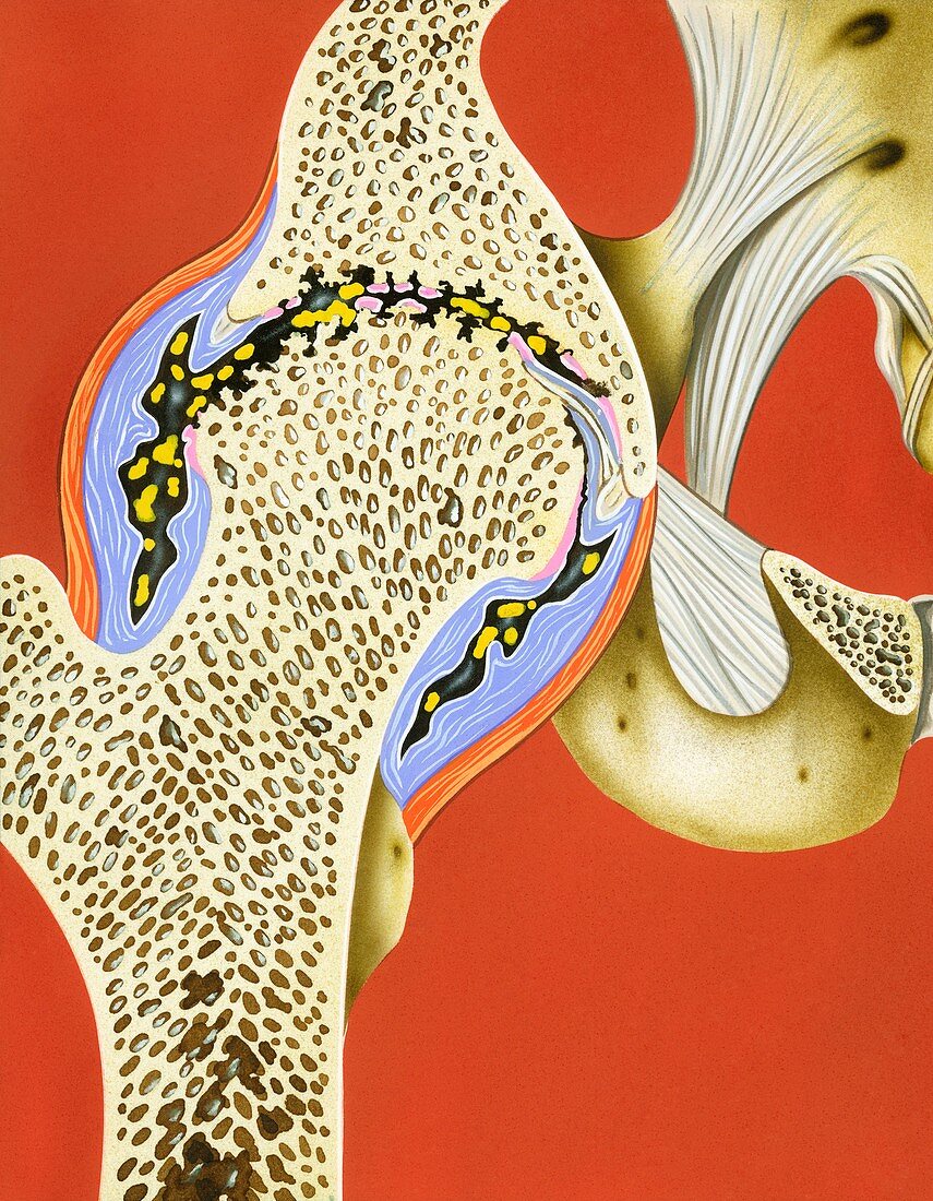 Hip joint cartilage loss,illustration