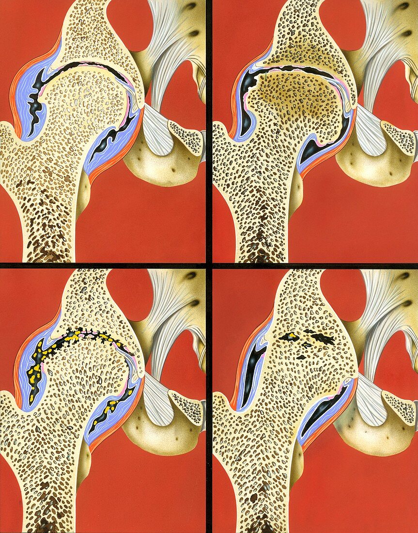 Hip joint degeneration,illustration