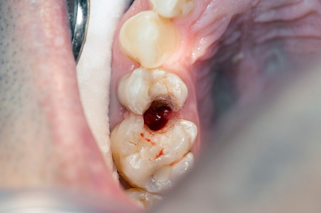 Decay cavity in premolar and molar teeth