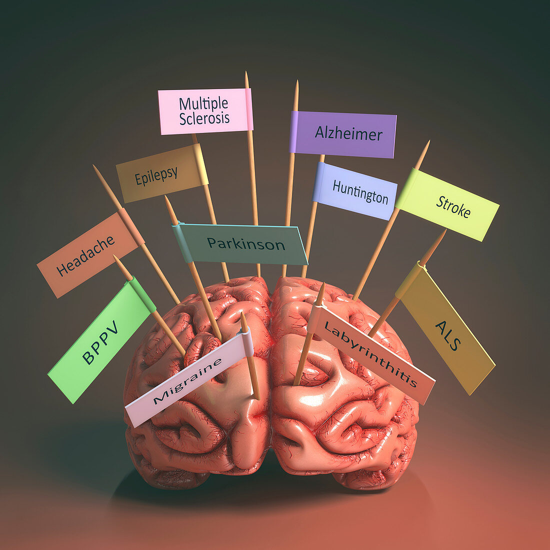 Human brain with medical conditions