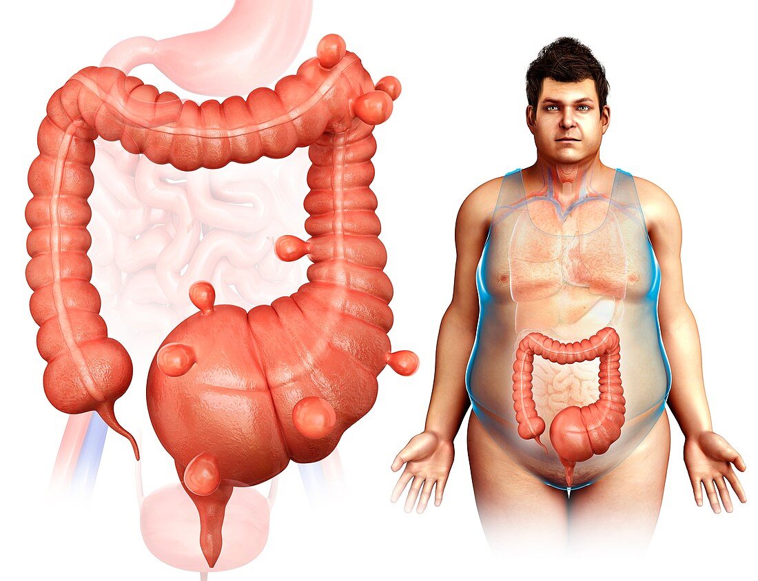 Diverticulosis,illustration