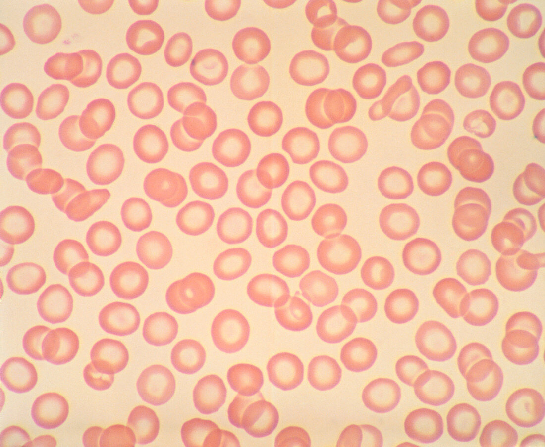 Light micrograph of iron deficient red blood cells