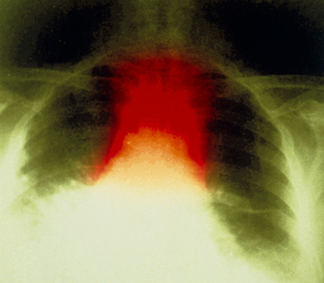 Pulmonary anthrax,X-ray