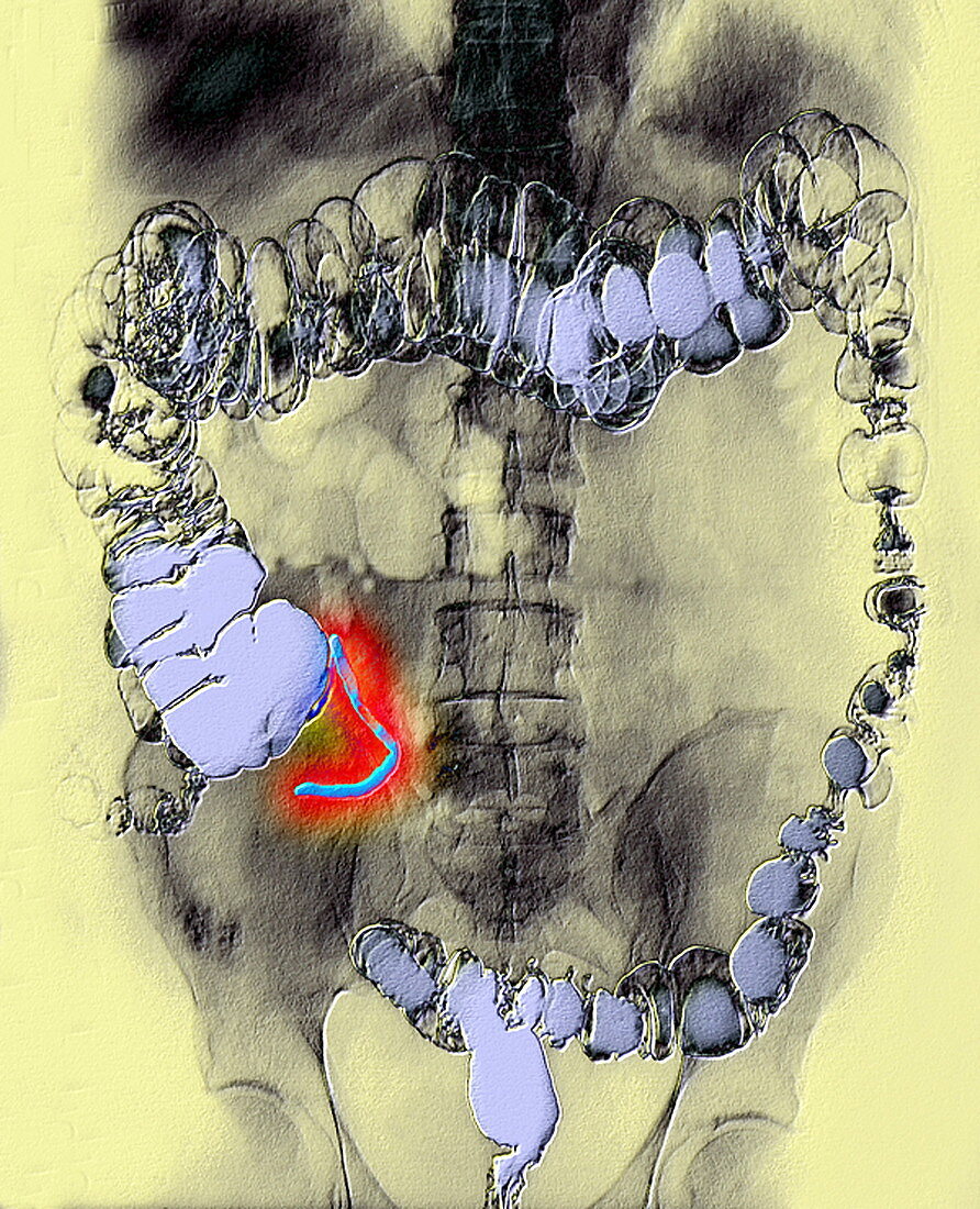 Abnormal appendix,X-ray