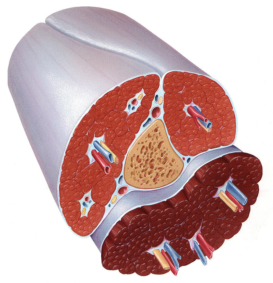 Compartment Syndrome