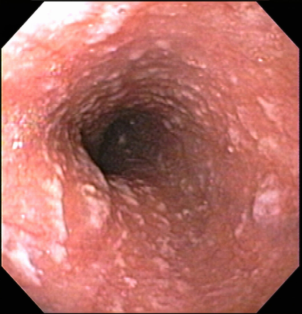 Candida esophagitis