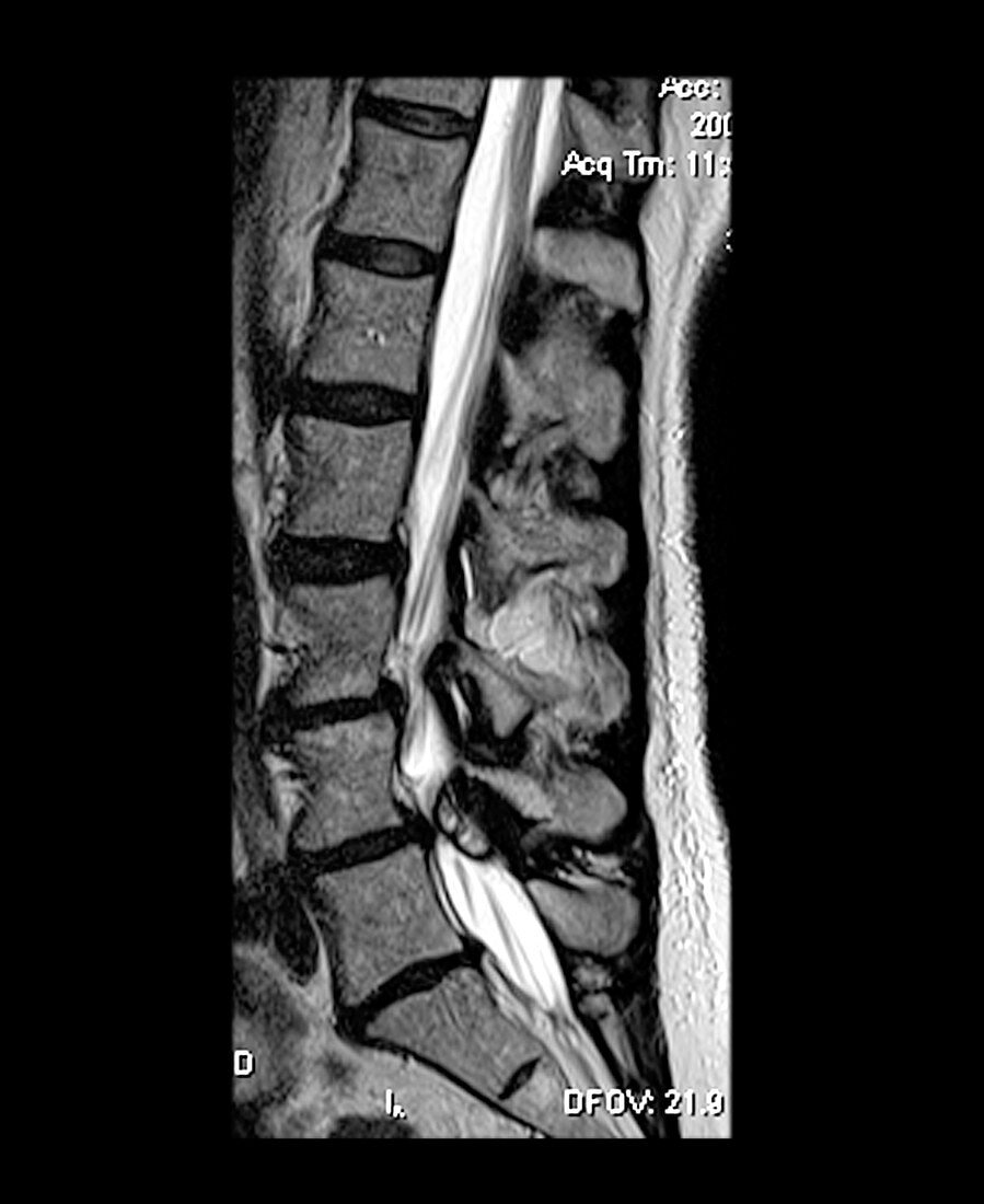 Large Synovial Cyst with Spinal Steno