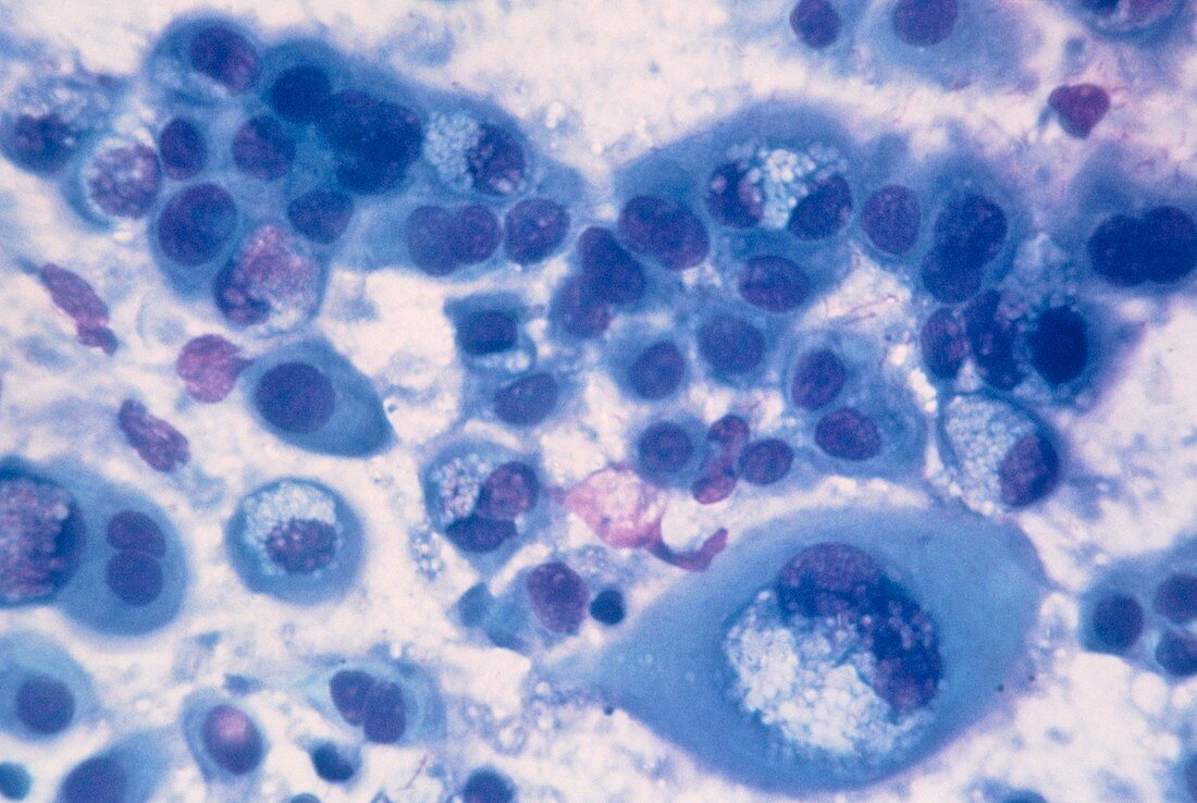 LM of biopsy cells showing adenocarcinoma