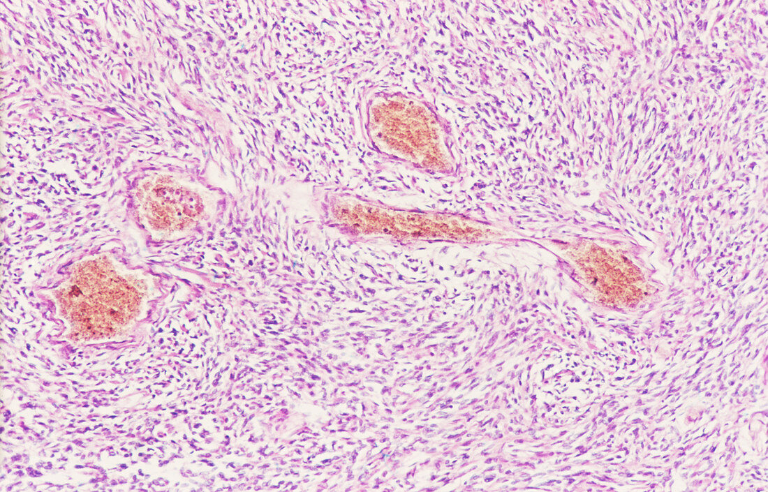 Lung cancer,spindel cell carcinoid