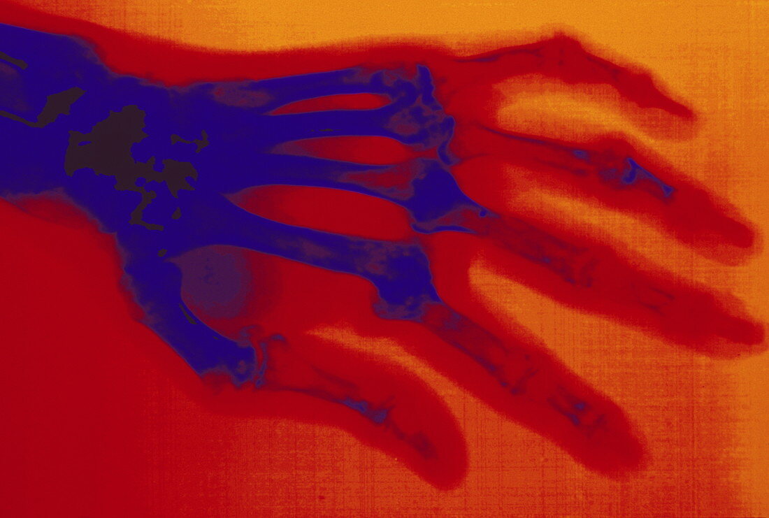 F/colour X-ray of hand with rheumatoid arthritis