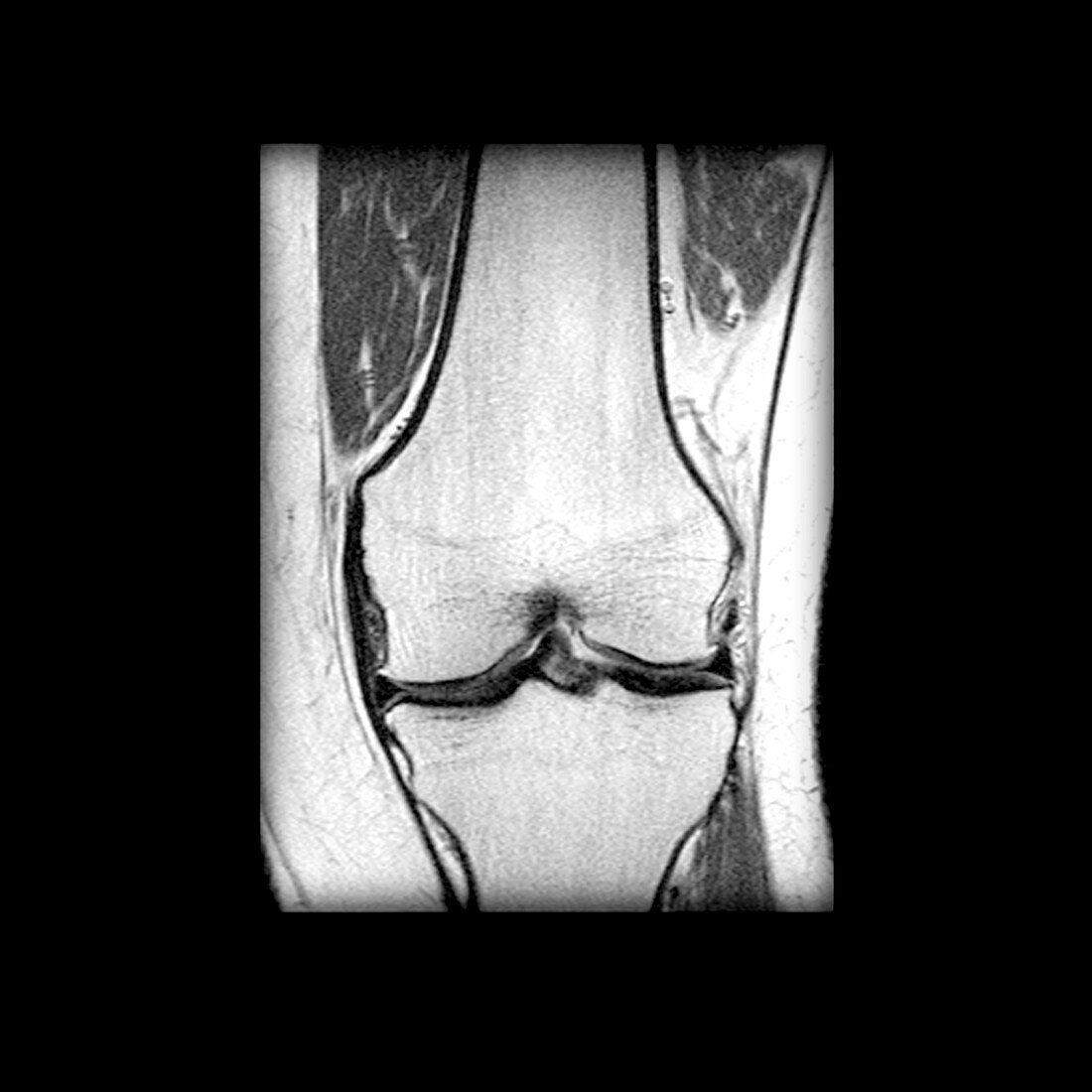 MRI of knee with osteoarthritis