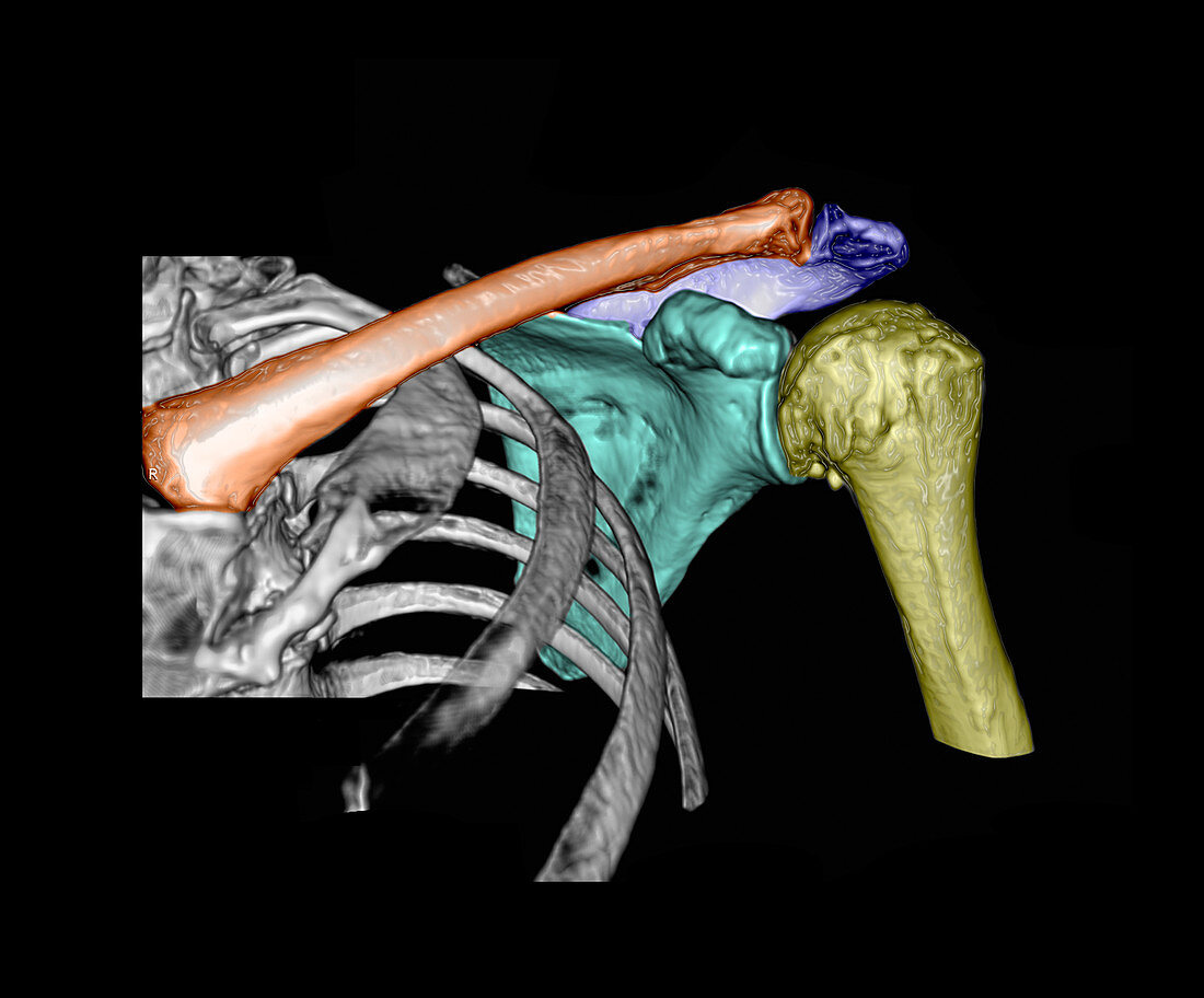 Enhanced 3D CT of the Shoulder