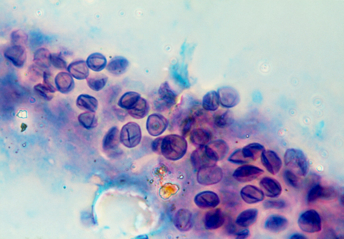 LM of Pneumocystis carinii cysts from AIDS lung