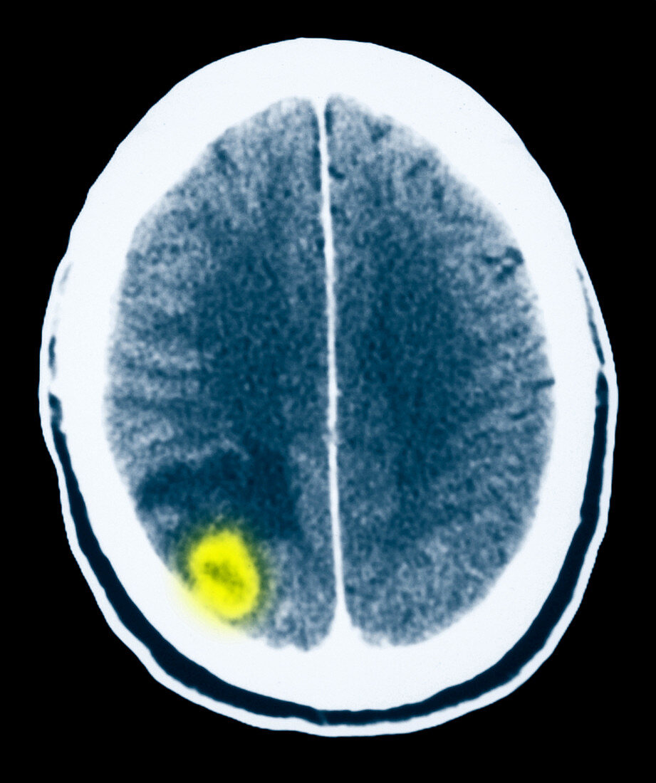 Toxoplasmosis of the Brain