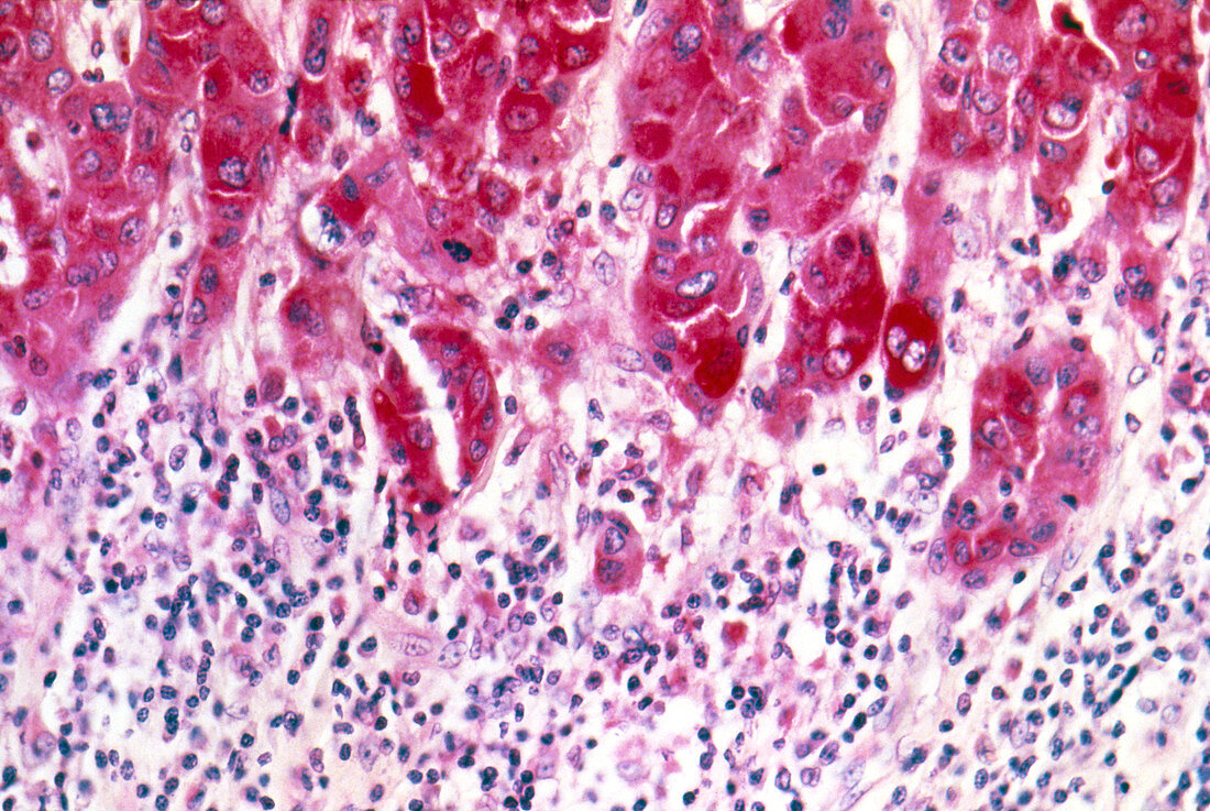 LM of carcinoma cells of breast cancer