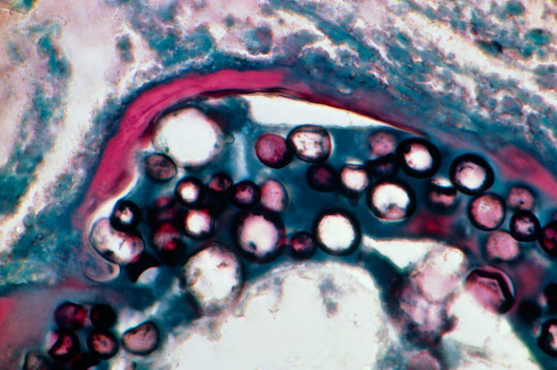 LM of Coccidioides immitis spores in human lung